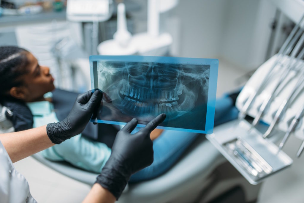Leczenie kanałowe, zwane również endodontycznym, to procedura mająca na celu uratowanie silnie uszkodzonych zębów przed ekstrakcją